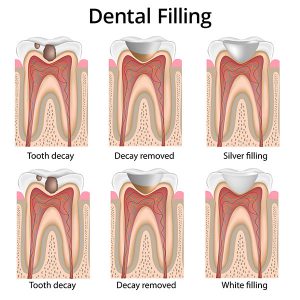dental-fillings
