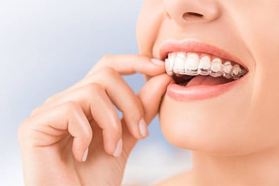 Updated: The Clear Invisalign® Advantage: A Comprehensive Guide to Straightening Your Teeth