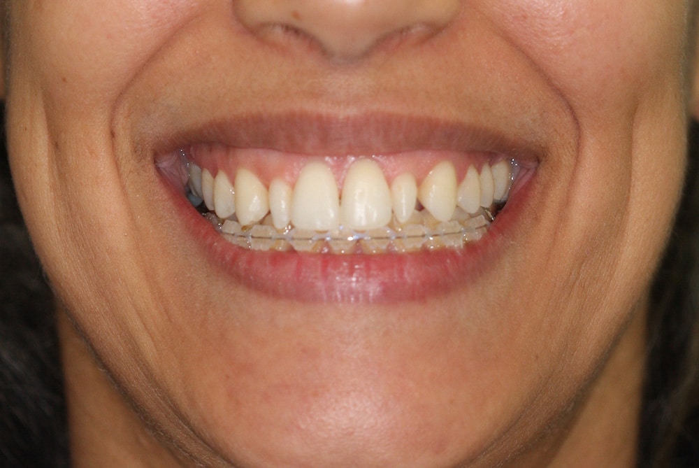 Pre-transformation photo natural tooth appearance