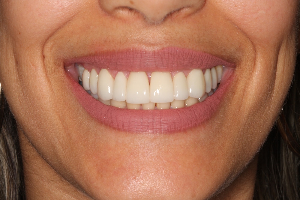 Transformed smile following dental veneers procedure