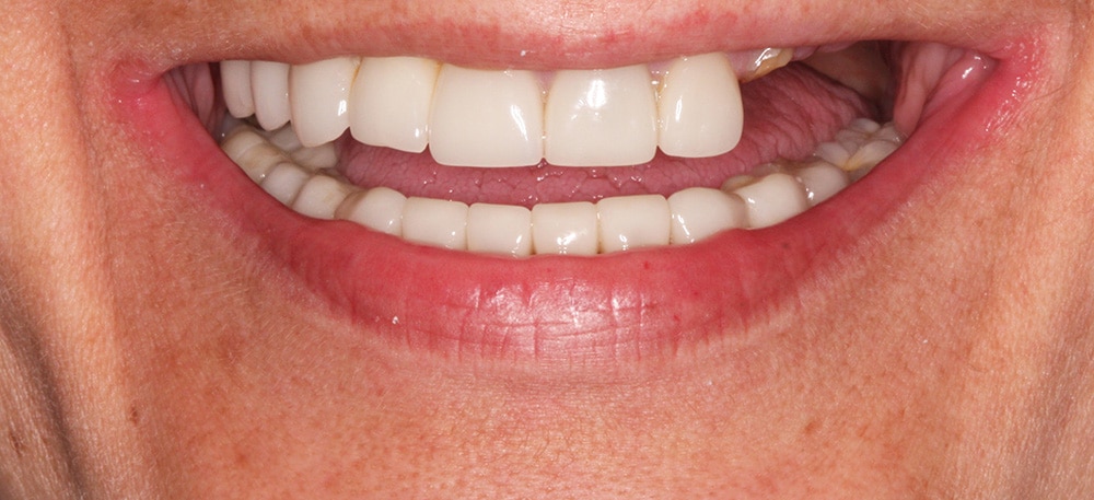 Pre-implant photo illustrating tooth loss