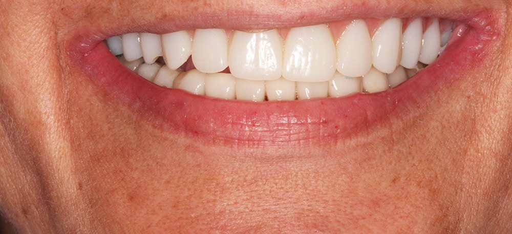 Implants success: transformed smile post-implantation