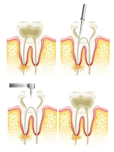 Updated: Root Canals Do Not Need To Hurt