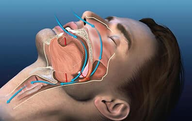 Updated: Why Can Snoring Be Dangerous