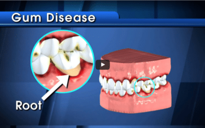 Updated: What Exactly Are Cavities Anyway?