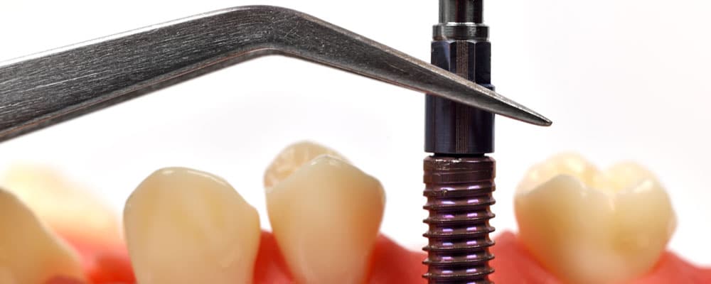 Dental Impants at DeJesus Dental Group