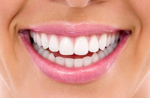 smile after teeth whitening 
