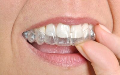 The Dos And Dont’s Of Invisalign