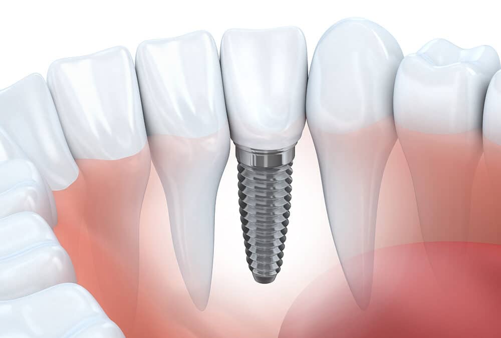 Single tooth implant vs. Full Mouth dental implants