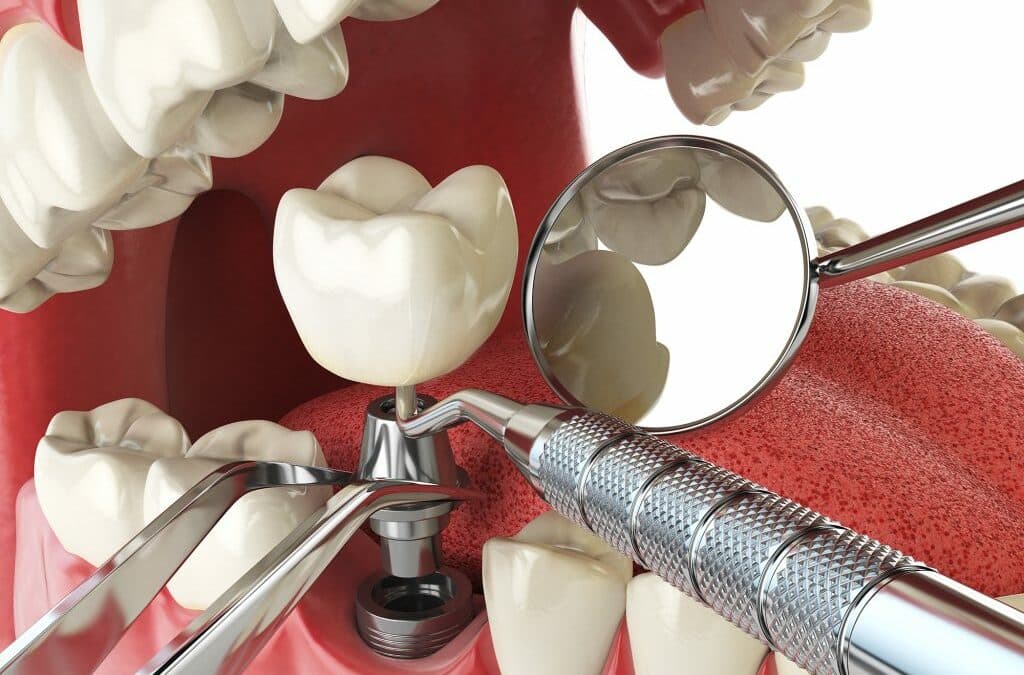 10 Questions To Ask Before Dental Implant Surgery