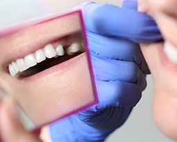 How To Care For Your Dental Bridge