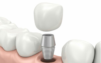 Why You Can (And Should) Get A Dental Implant