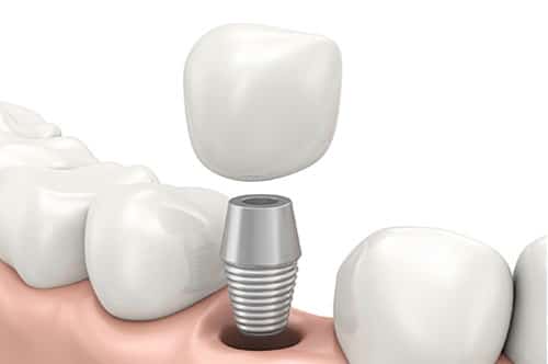 Why You Can (And Should) Get A Dental Implant