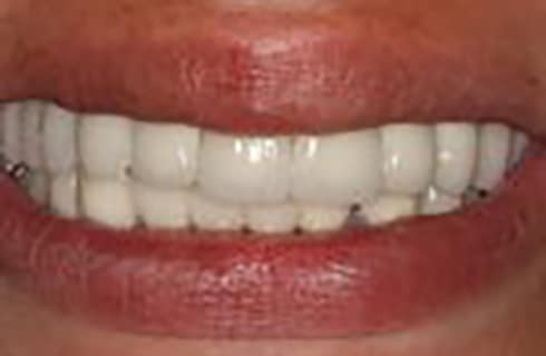 Smile after receiving implants at DeJesus Dental
