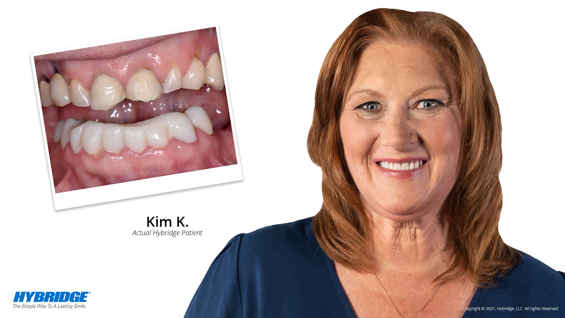 Hybridge Dental Implants patient before and after picture