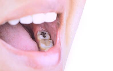 Still Have Silver Fillings? Here’s What You Should Do Next