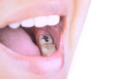 Still Have Silver Fillings? Here’s What You Should Do Next