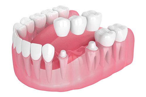 Dental Bridges