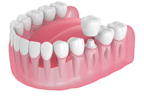 Dental Crowns