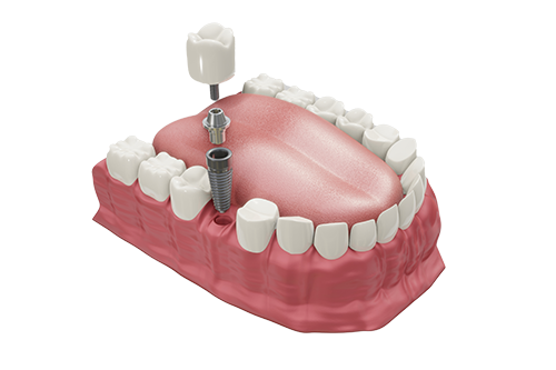 Dental Implants copy