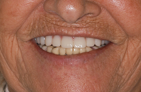 Before and after images of dental work.