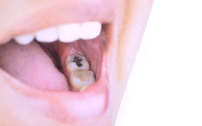 Still Have Silver Fillings? Here’s What You Should Do Next