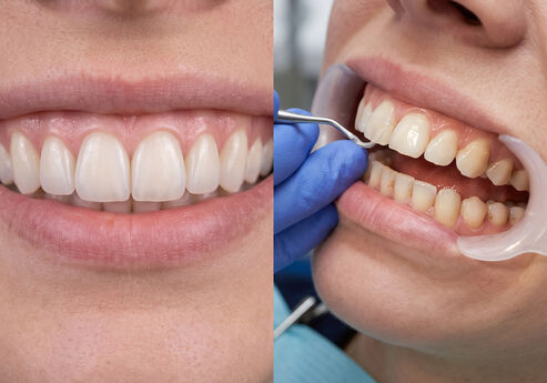 Veneers vs. Bonding: Which Cosmetic Option Is Right for You?